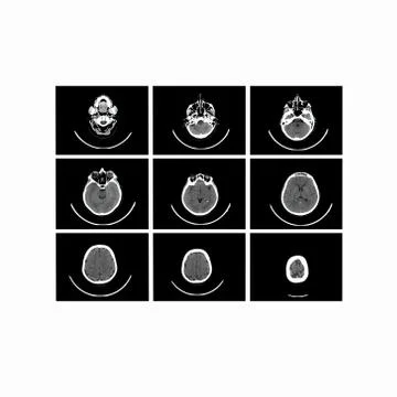 X-ray image of the brain computed tomography Illustrazione stock