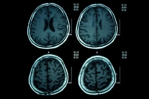 X-ray image of the brain computed tomography Stock Photos