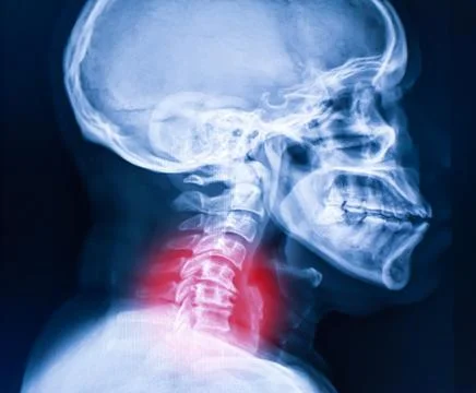 X-ray image of cervical spine, neck x-ray image Stock Photos