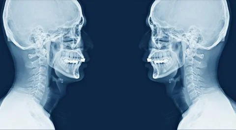 X-ray image of cervical vertebrae spine, part of vertebral column.Side view Stock Photos