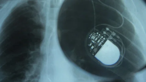 X-Ray Image of Chest with Artificial Cardiac Pacemaker Under Magnifying Glass Stock Footage 119452674