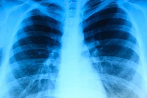 X-ray image of chest Foto stock