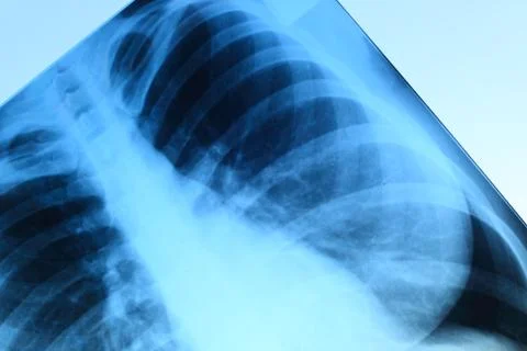 X-ray image of chest Stock-Fotos