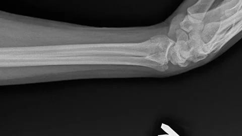 X-ray image of cracked human bone, zoom in Stock Footage 135040756