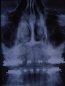 X-ray image of the dentition with braces and teeth Stock Photos