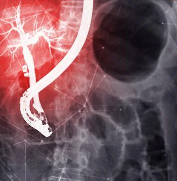 X-ray image of endoscopic after Doctor doing ERCP and laparoscopic cholecys.. Stock-Illustration