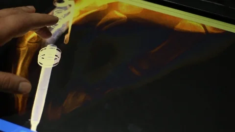 X  ray image of the hand with the pen Stock-Footage 100599106
