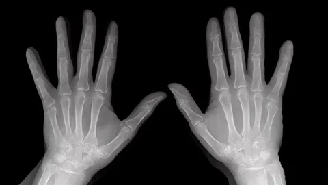 X-Ray Image Of Hands Showcasing Skeletal Structure, Fingers And Joints For Study Stock Footage 318123484