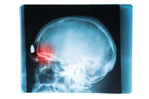 X-ray image of head and brain skull with red pain point in frontal sinuses Stock Photos