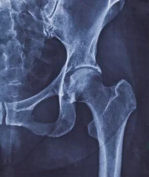 X-ray image of hip joint with signs of coxarthrosis Stock Photos