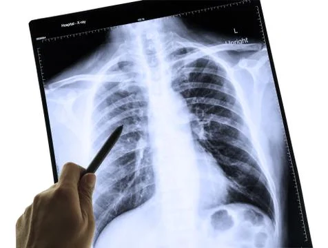 X-ray image of human chest for a medical diagnosis and hand pointing Stock Photos