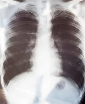 X-ray image of human chest Stock Photos