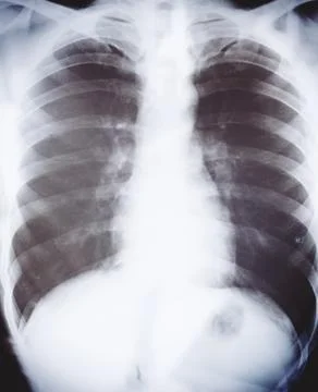 X-ray image of human chest Stock Photos