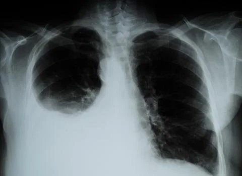 X-ray image of Human Chest Stock Photos