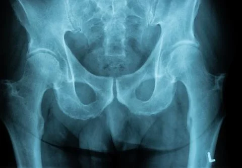 X-Ray Image of a Human Chest for a medical diagnosis Stock Photos