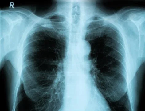 X-Ray Image Of Human Chest Foto stock