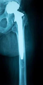 X-Ray Image of a Human Chest with Artificial hip joint Foto stock