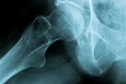X-Ray Image of a Human Chest hip joint bone Stock Photos