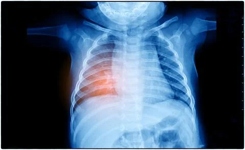 X-Ray Image Of Human Chest for a medical diagnosis, coronavirus or Covid-19.. Stock Photos