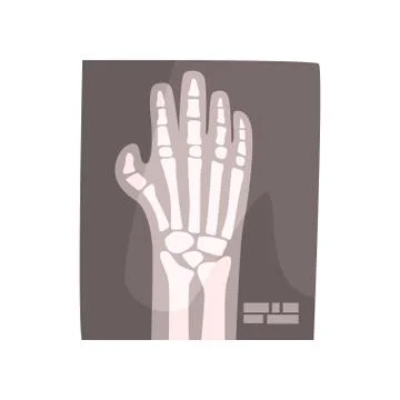 X ray image of human hand cartoon vector Illustration Stock Illustration