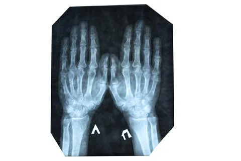 X-Ray Image of Human hands bones. Skeletal structure for medical analysis o.. Stockfoto's