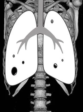X-Ray Image Of Human Healthy Chest looks narmal.Medical image concept. Stock Illustration