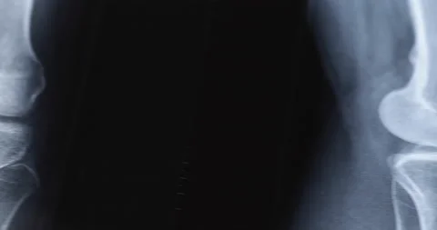 X-ray image of human knee. Problems with bone or joint. Stock Footage 233330475