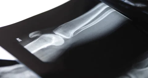X-ray image of human knee. Problems with bone or joint. Stock-Footage 233331975
