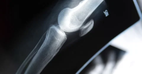 X-ray image of human knee. Problems with bone or joint. Stock-Footage 233332289