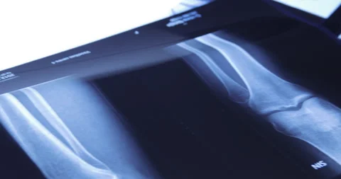 X-ray image of human knee. Problems with bone or joint. Stock-Footage 233333078