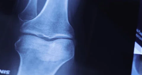 X-ray image of human knee. Problems with bone or joint. Stock-Footage 233334349