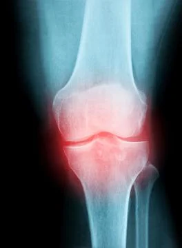 X-Ray Image of a Human knee joint for a medical diagnosis Stock Photos