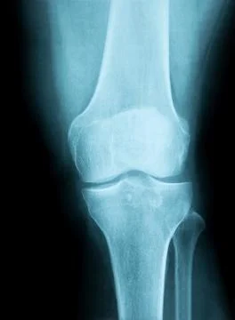 X-Ray Image of a Human knee joint Stock Photos