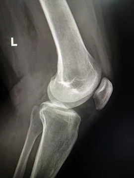 X-ray image of a human knee joint with clear bone structure Stock Photos