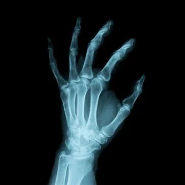 X-ray Image of a human left hand Stock Photos