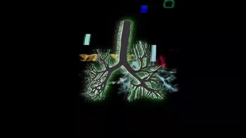 X-ray image of human lungs on black. Glitch effect, ripples. Stock Footage 304030663