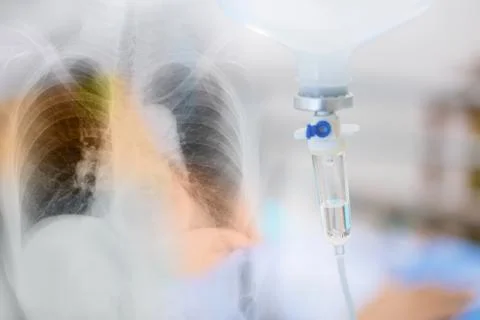 X-Ray Image of human lungs for a medical coronavirus covid-19 diagnosis. and  Stock Photos
