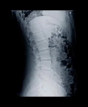 X-ray image of human normal spine, rips, pelvis. Stock Photos