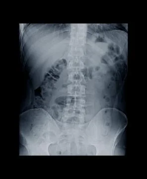 X-ray image of human normal spine, rips, pelvis. Stock Photos