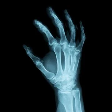 X-ray Image of a human right hand for a medical diagnosis Foto stock