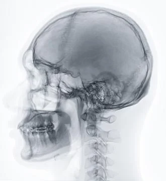 X-ray image of Human Skull   lateral view for diagnosis skull fracture  iso.. Stock Illustration