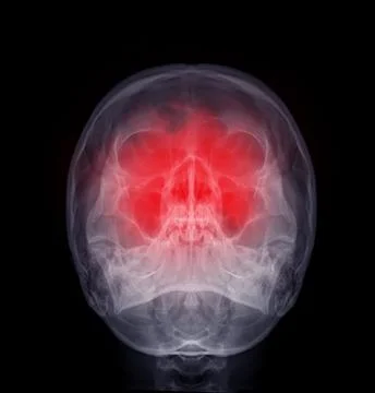 X-ray image of Human Skull   Water's view for diagnosis skull fracture  iso.. Stock Illustration