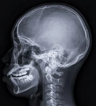 X-ray image of Human Skull   lateral view for diagnosis skull fracture  iso.. Stock-Illustration