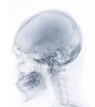 X-ray image of Human Skull   lateral view for diagnosis skull fracture  iso.. Stock-Illustration