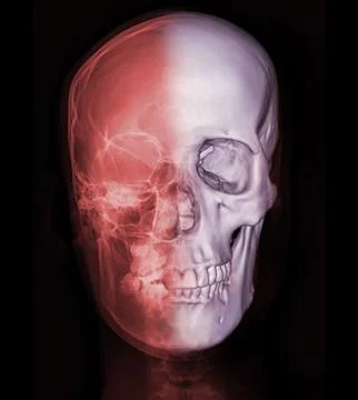 X-ray image of Human Skull   Front  view for diagnosis skull fracture  isol.. Stock Illustration