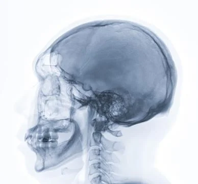 X-ray image of Human Skull   lateral view for diagnosis skull fracture  iso.. Stock Illustration