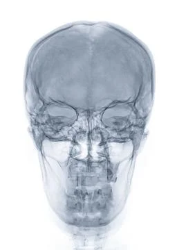 X-ray image of Human Skull   Front  view for diagnosis skull fracture  isol.. Stock Illustration