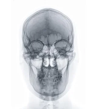X-ray image of Human Skull   Front  view for diagnosis skull fracture  isol.. Stock-Illustration