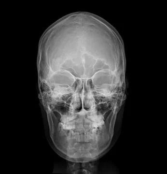 X-ray image of Human Skull   Front  view for diagnosis skull fracture  isol.. Stock Illustration