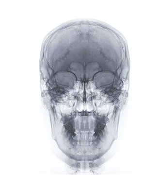 X-ray image of Human Skull   Front  view for diagnosis skull fracture  isol.. Stock Illustration